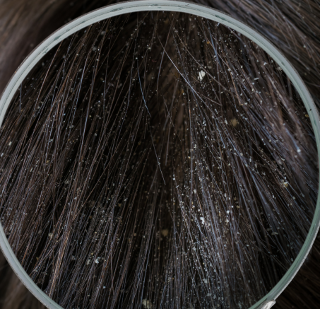 Łupież u psa: Przyczyny, objawy i sposoby leczenia