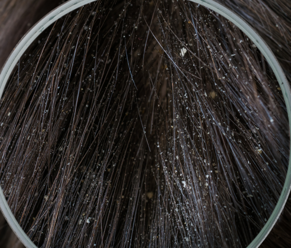 Łupież u psa: Przyczyny, objawy i sposoby leczenia